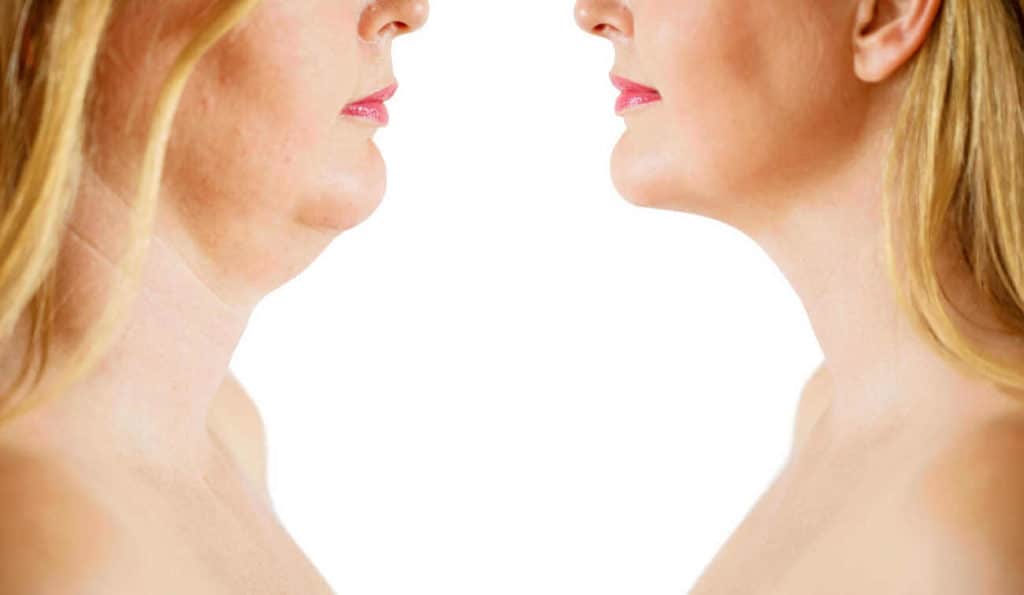 Double Chin treatment Buxton before and after results