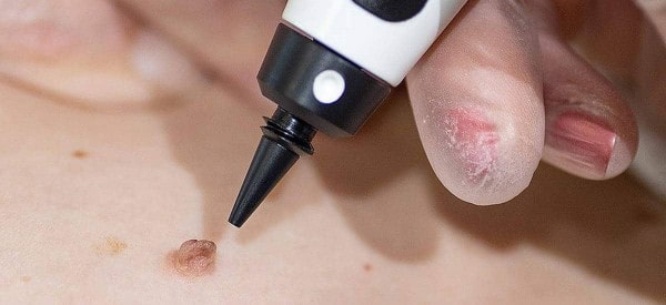 After Skin Tag Removal Buxton