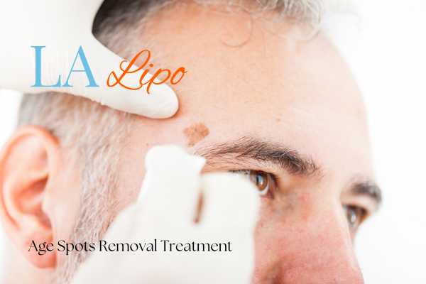 What Are the Most Effective Treatments for Age Spots Buxton?
