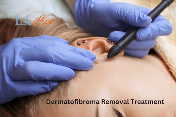 Dermatofibroma Removal Treatment Buxton