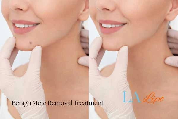 woman's before and after mole removal Buxton results