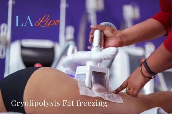 women getting fat freezing Buxton