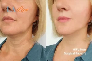 hi-fu for wrinkles Buxton before and after results