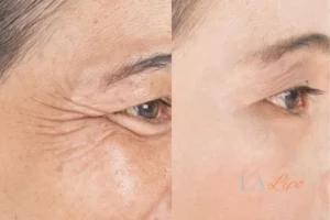 Before and after results of woman - HI-fu wrinkles reduction treatment Buxton