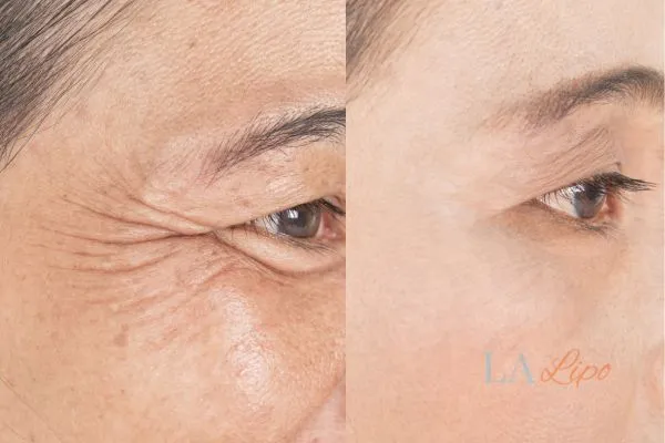 Before and after results of woman - HI-fu wrinkles reduction treatment Buxton