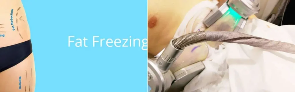 Fat freezing Buxton on multiple areas of the body