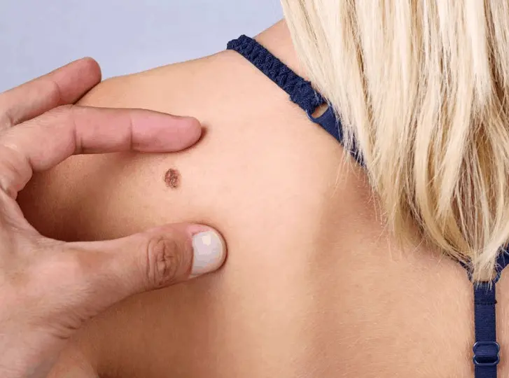 woman having mole removal Buxton consultation before treatment.