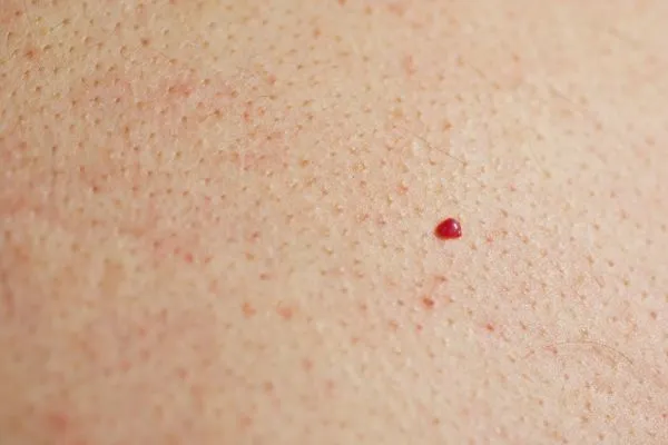 close up of a cherry angioma Buxton