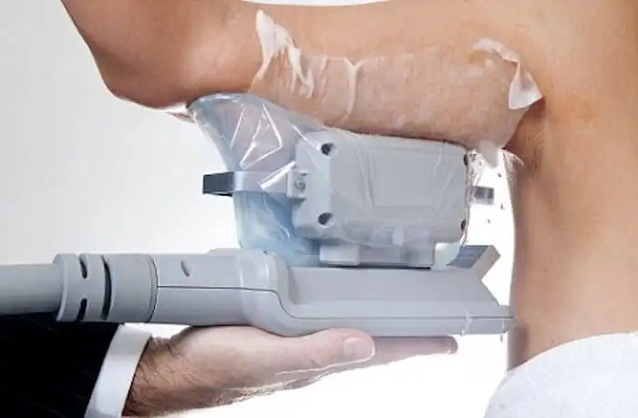 Picture of fat freezing Buxton on the upper arms.