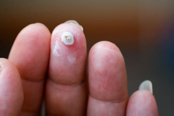 wart on person finger - cryotherapy to treat from LA LIPO Buxton