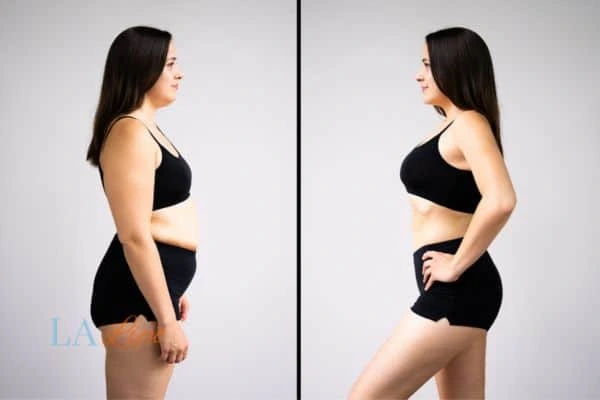 Picture of womans before and after using LA-EMS body sculpting to improve her core strength Buxton