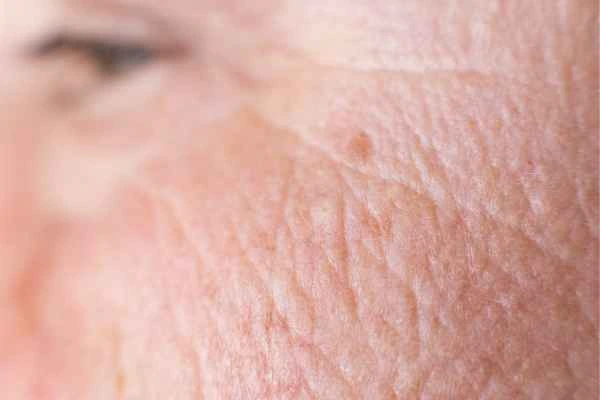 close up picture of a woman's face showing an age spot Buxton