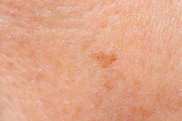 close up picture of age spots Buxton