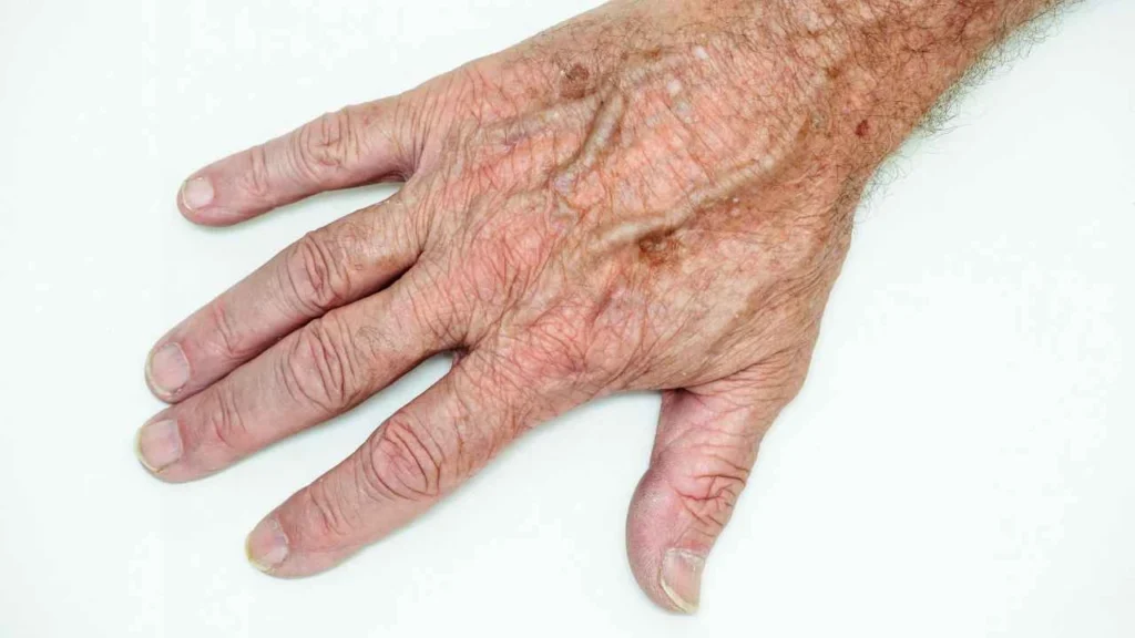 Male hand showing age spot Buxton