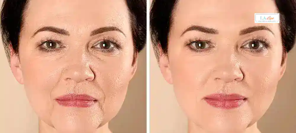 How Long Does It Take to See Results and How Long Do They Last Buxton?