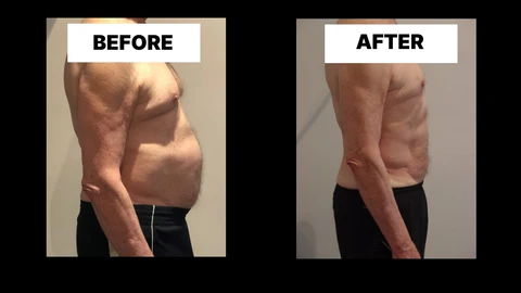 What Symptoms Can Diastasis Recti Cause in Men? Weak Core, Back Pain and Poor Posture Buxton